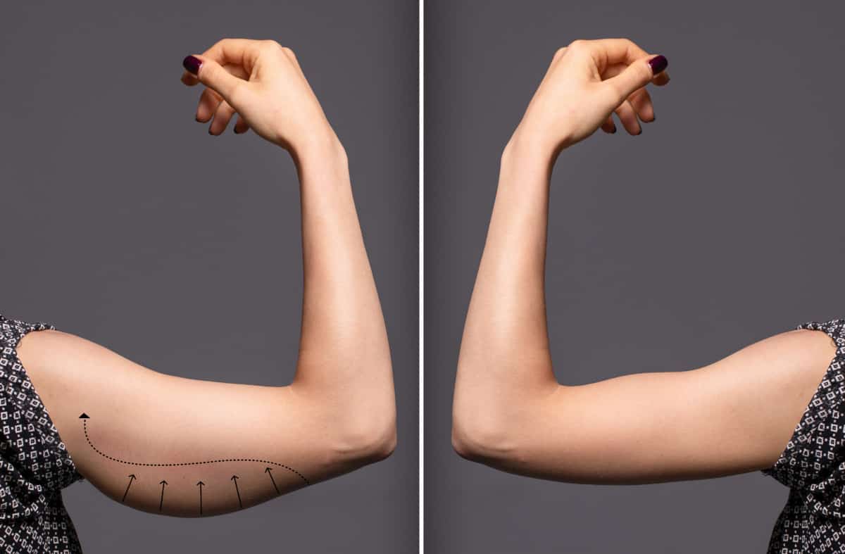 before and after flabby arms