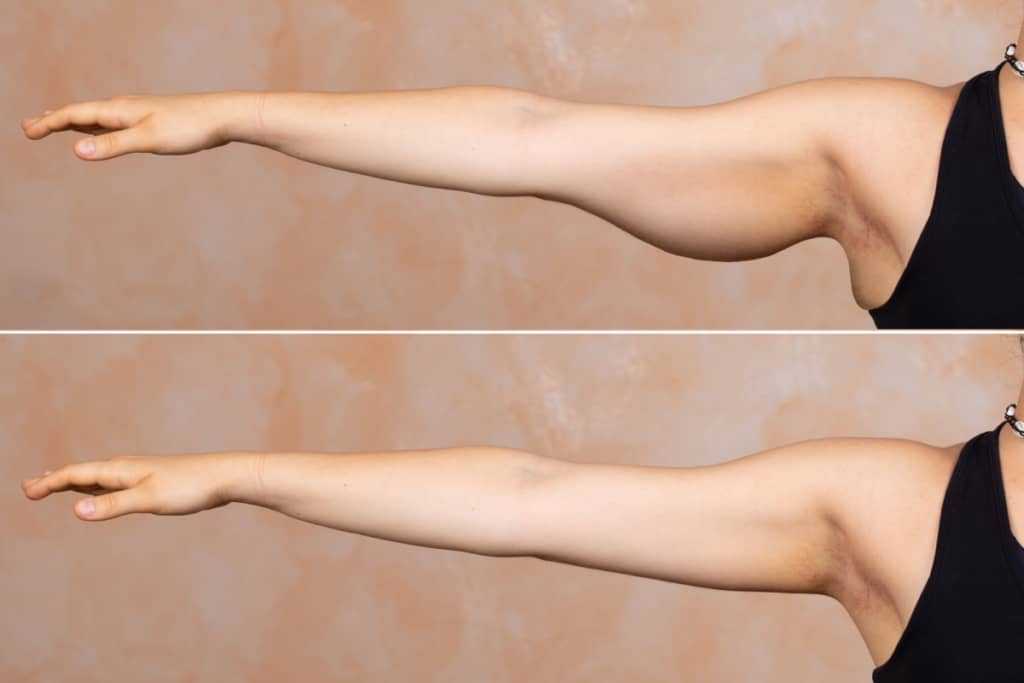 upper arm fat loss before and after
Exercises To Get Rid of Upper Arm Fat 