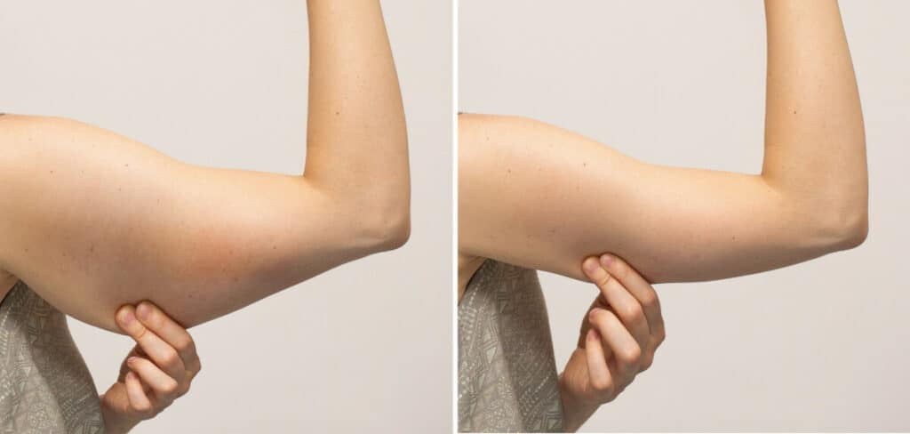 flabby arms before after exercise