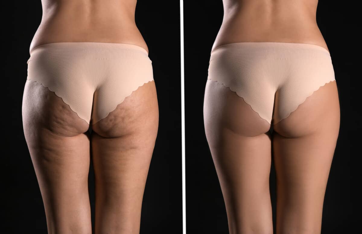 collagen cellulite before and after