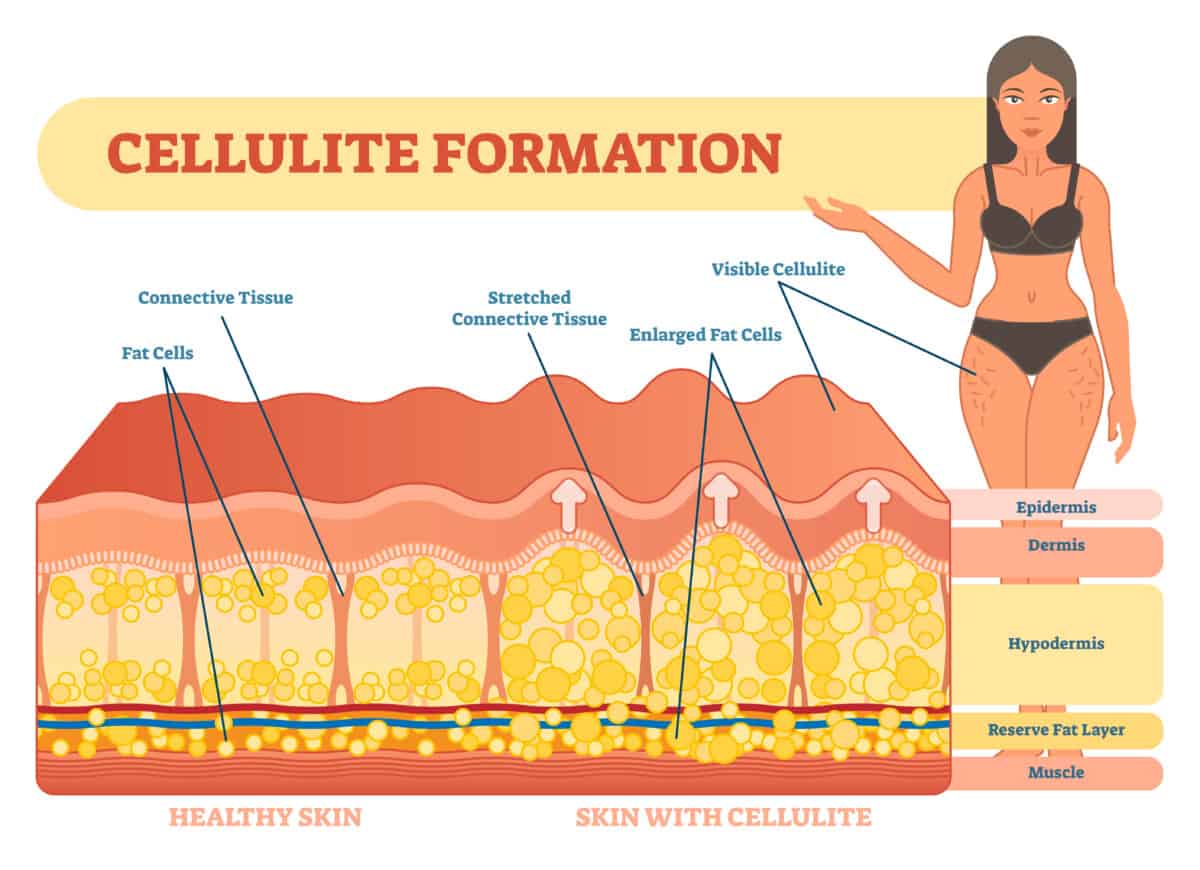 collagen formation fat pushing