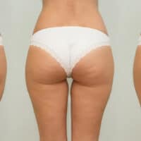 does collagen reduce cellulite