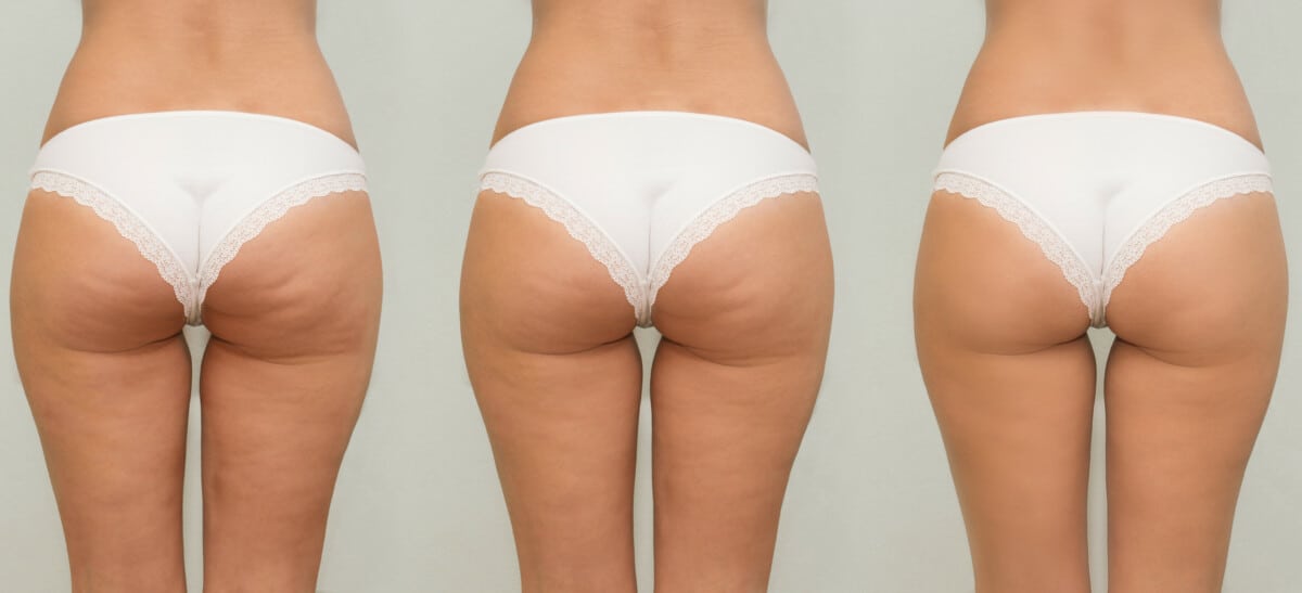 does collagen help with cellulite