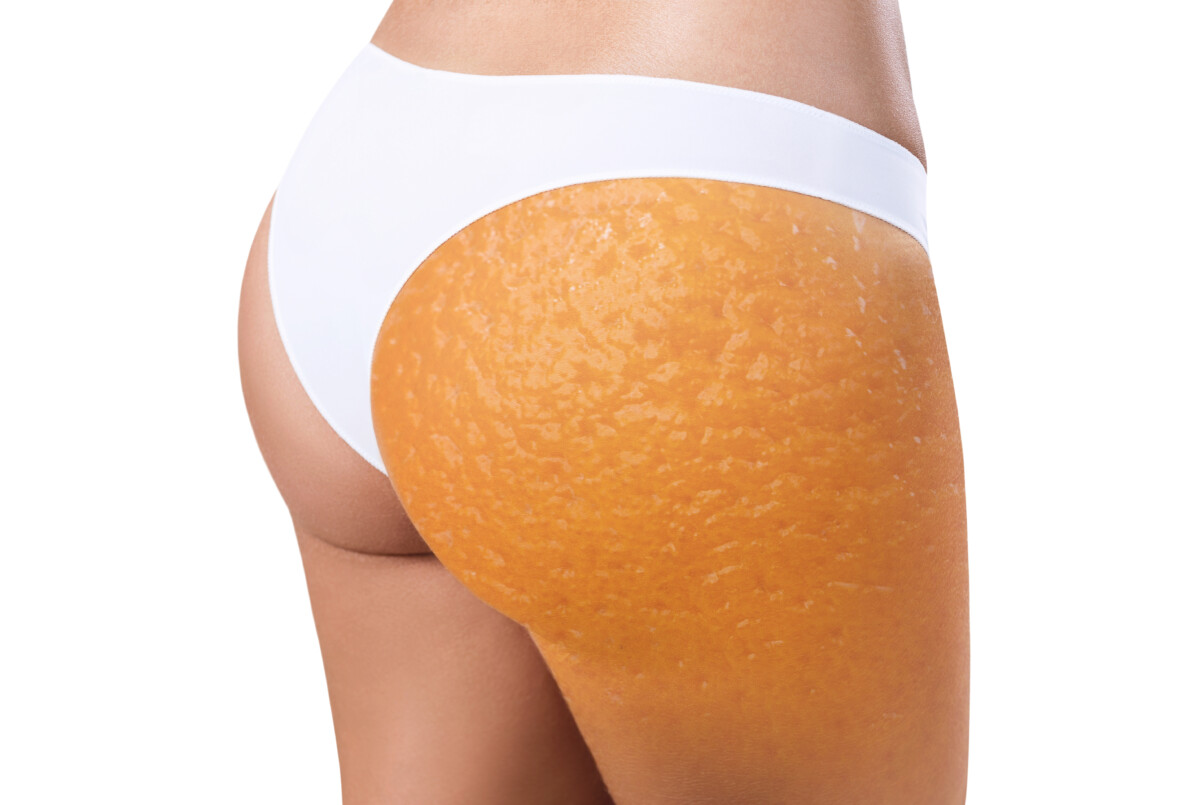 can intermittent fasting reduce cellulite