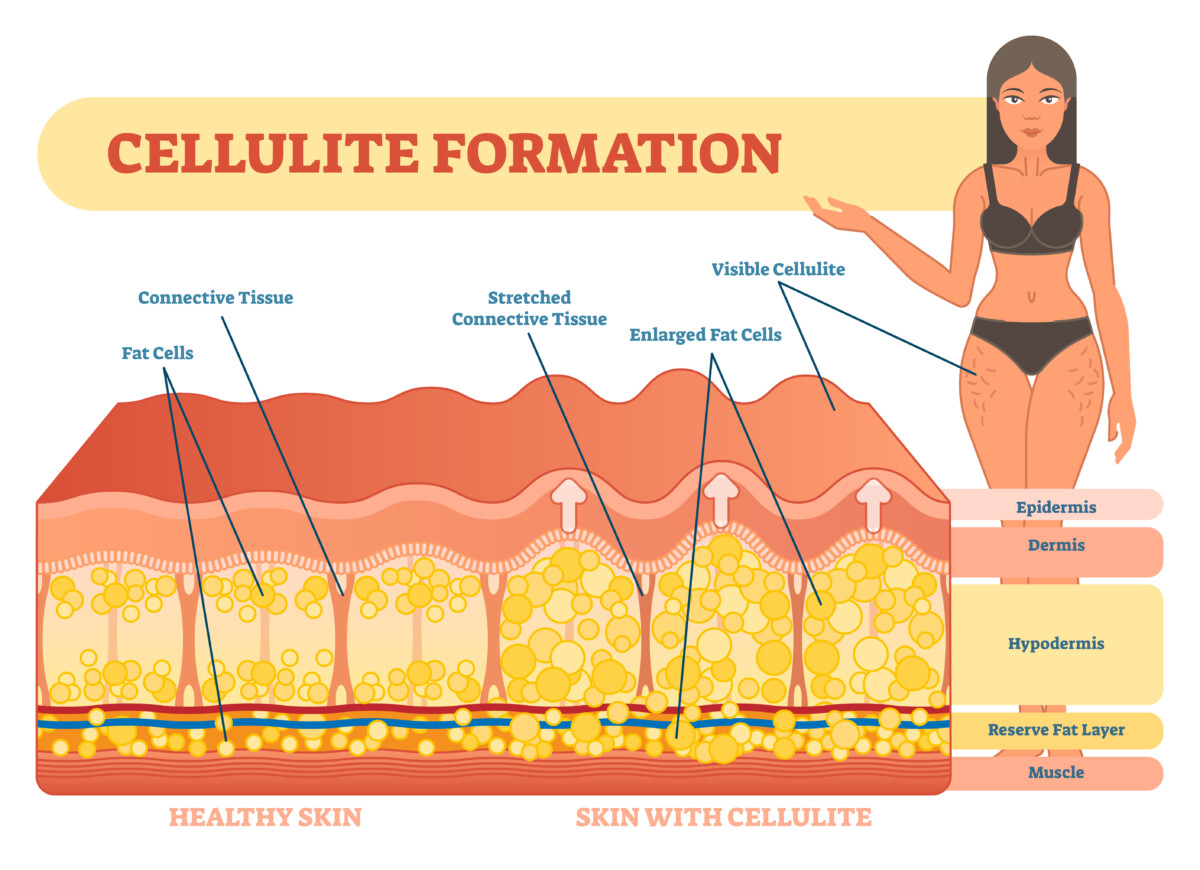 cellulite formation